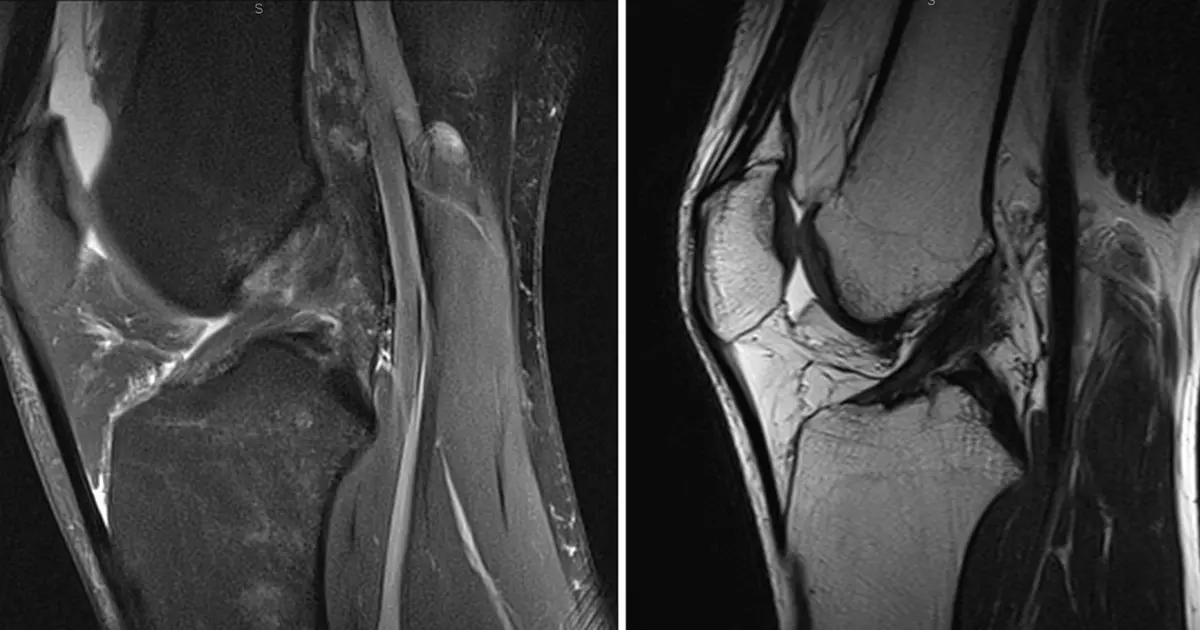 Može li prednji križni ligament (ACL) zacijeliti?