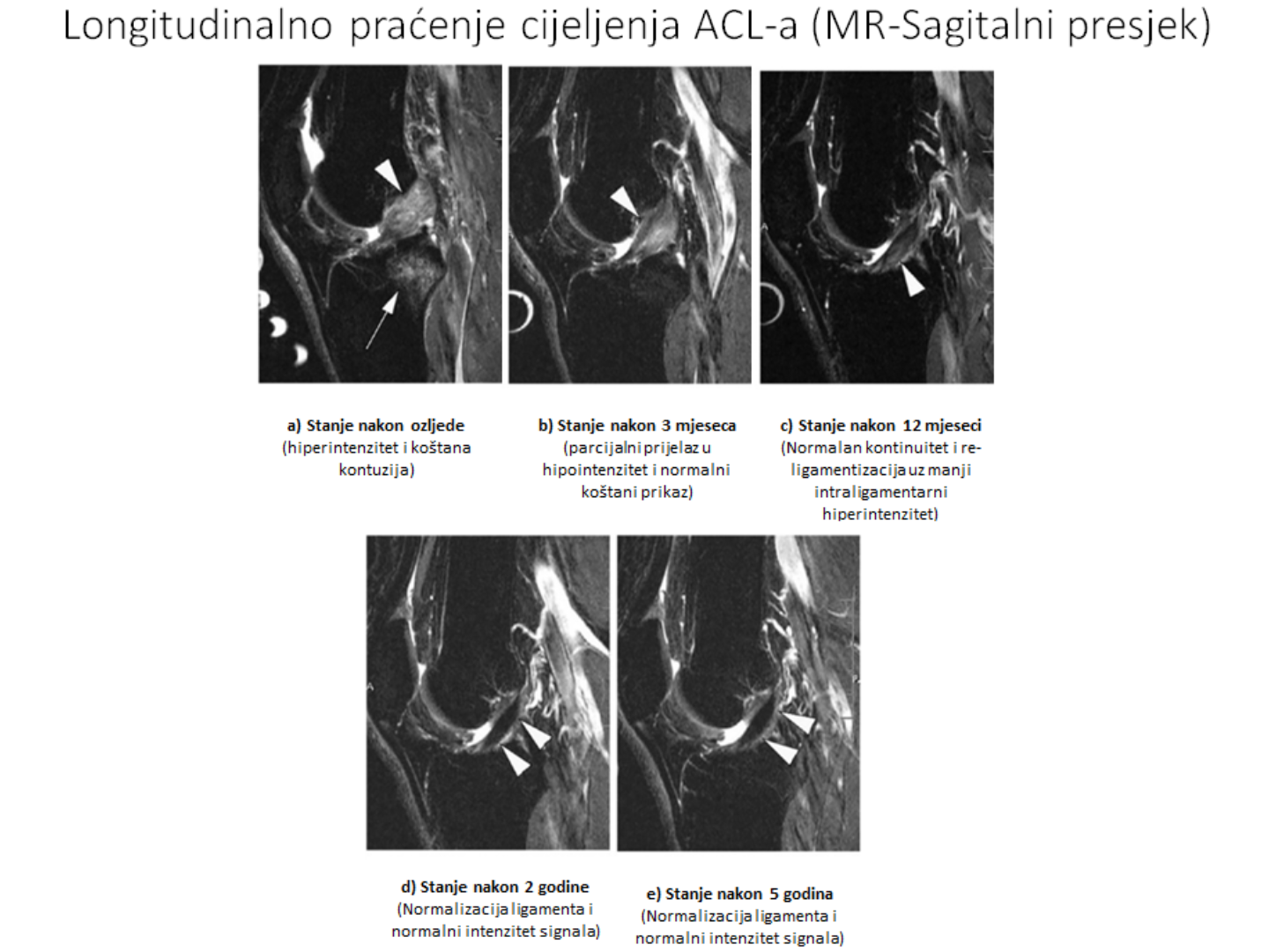 Može li prednji križni ligament (ACL) zacijeliti? Može li acl zacijeliti